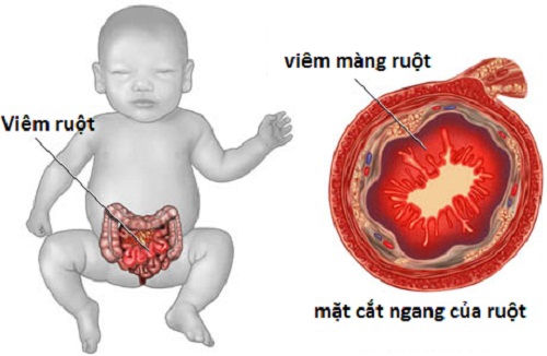 Trẻ bị viêm ruột dẫn đến hấp thu và tiêu hóa kém Trẻ bị viêm ruột dẫn đến hấp thu và tiêu hóa kém.